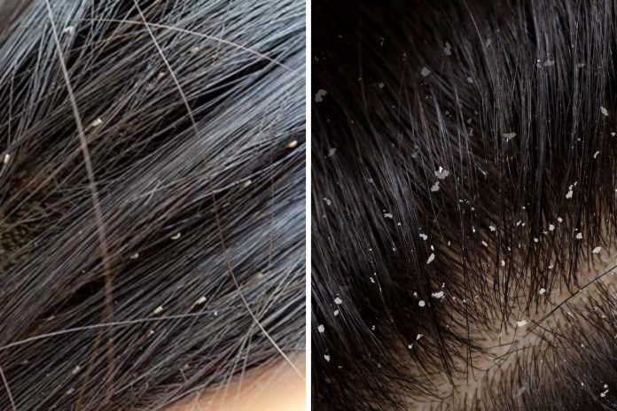 lice vs dandruff